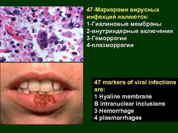 47 -Маркерами вирусных инфекций являются: 1 -Гиалиновые мембраны 2 -внутриядерные включения 3 -Геморрагии 4