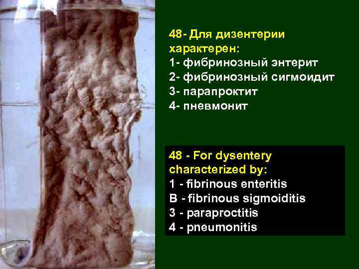 48 - Для дизентерии характерен: 1 - фибринозный энтерит 2 - фибринозный сигмоидит 3