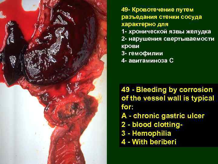49 - Кровотечение путем разъедания стенки сосуда характерно для 1 - хронической язвы желудка