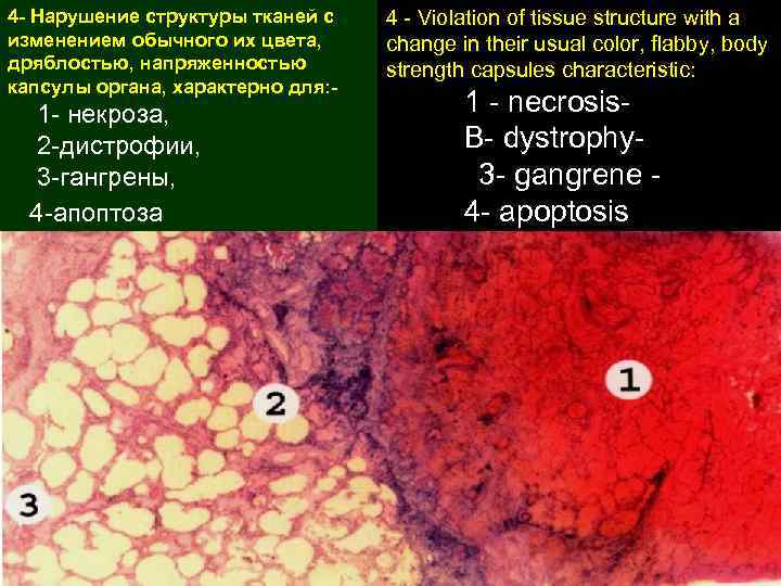 4 - Нарушение структуры тканей с изменением обычного их цвета, дряблостью, напряженностью капсулы органа,