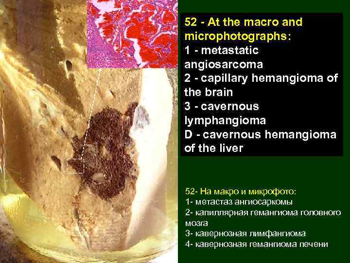 52 - At the macro and microphotographs: 1 - metastatic angiosarcoma 2 - capillary