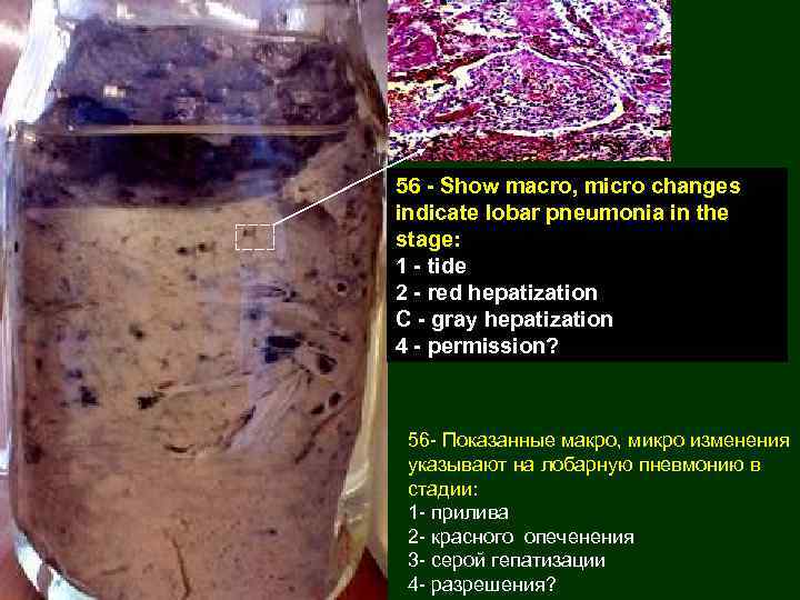 56 - Show macro, micro changes indicate lobar pneumonia in the stage: 1 -