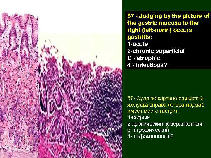 57 - Judging by the picture of the gastric mucosa to the right (left-norm)