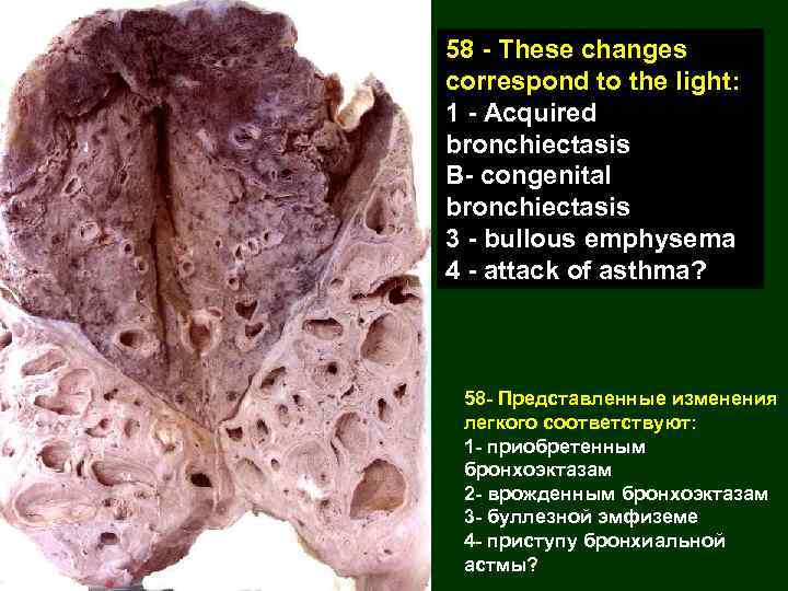 58 - These changes correspond to the light: 1 - Acquired bronchiectasis B- congenital