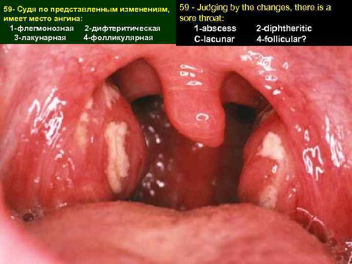 59 - Судя по представленным изменениям, имеет место ангина: 1 -флегмонозная 2 -дифтеритическая 3