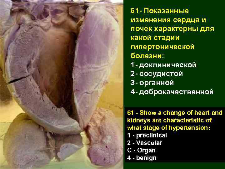 61 - Показанные изменения сердца и почек характерны для какой стадии гипертонической болезни: 1