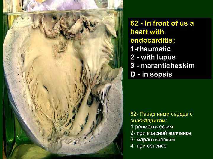 62 - In front of us a heart with endocarditis: 1 -rheumatic 2 -
