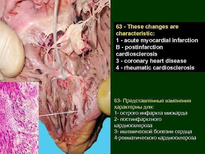 63 - These changes are characteristic: 1 - acute myocardial infarction B - postinfarction