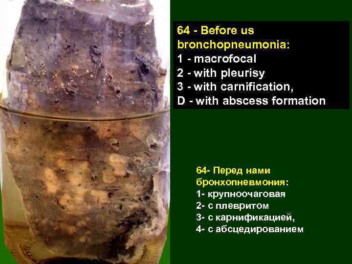64 - Before us bronchopneumonia: 1 - macrofocal 2 - with pleurisy 3 -