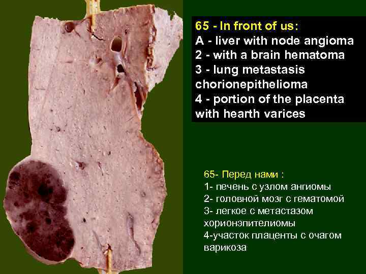 65 - In front of us: A - liver with node angioma 2 -