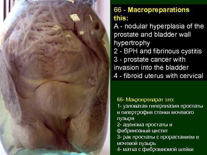 66 - Macropreparations this: A - nodular hyperplasia of the prostate and bladder wall