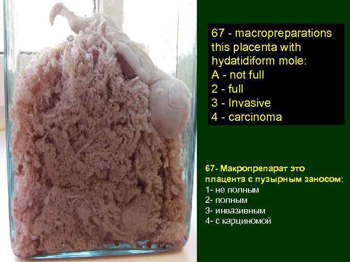 67 - macropreparations this placenta with hydatidiform mole: A - not full 2 -