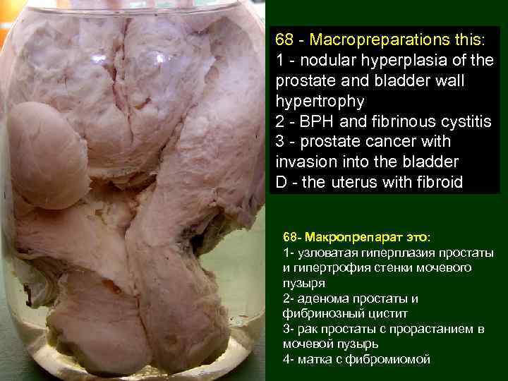68 - Macropreparations this: 1 - nodular hyperplasia of the prostate and bladder wall