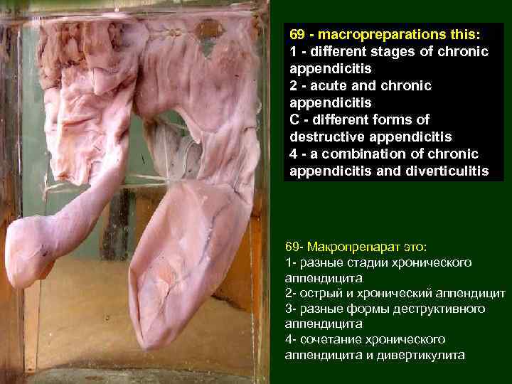 69 - macropreparations this: 1 - different stages of chronic appendicitis 2 - acute