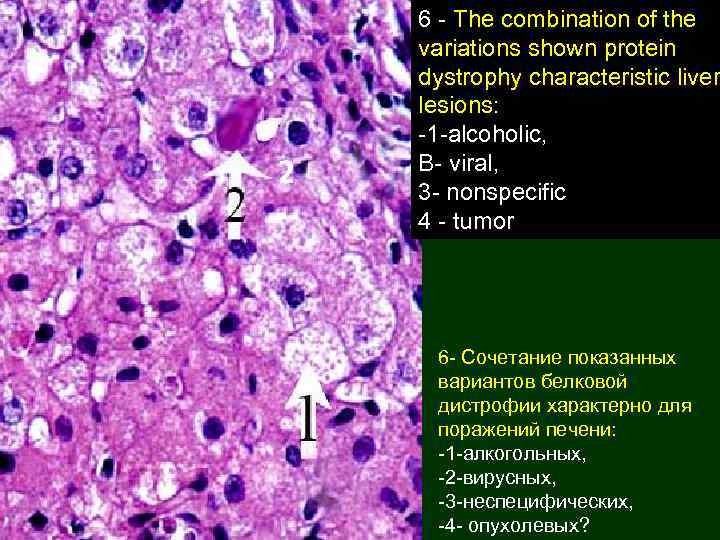 6 - The combination of the variations shown protein dystrophy characteristic liver lesions: -1