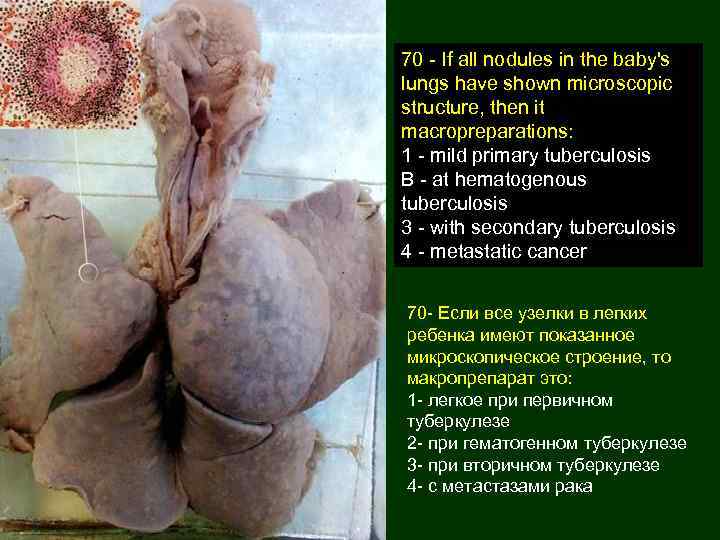 70 - If all nodules in the baby's lungs have shown microscopic structure, then