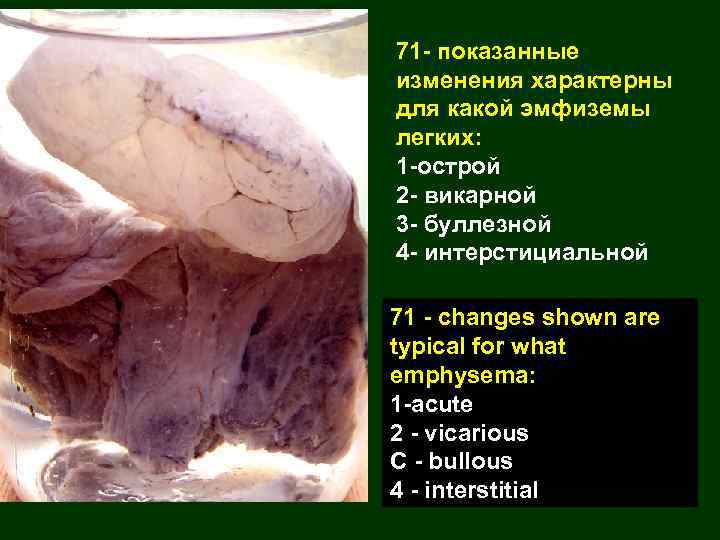 71 - показанные изменения характерны для какой эмфиземы легких: 1 -острой 2 - викарной