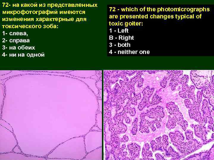 72 - на какой из представленных микрофотографий имеются изменения характерные для токсического зоба: 1