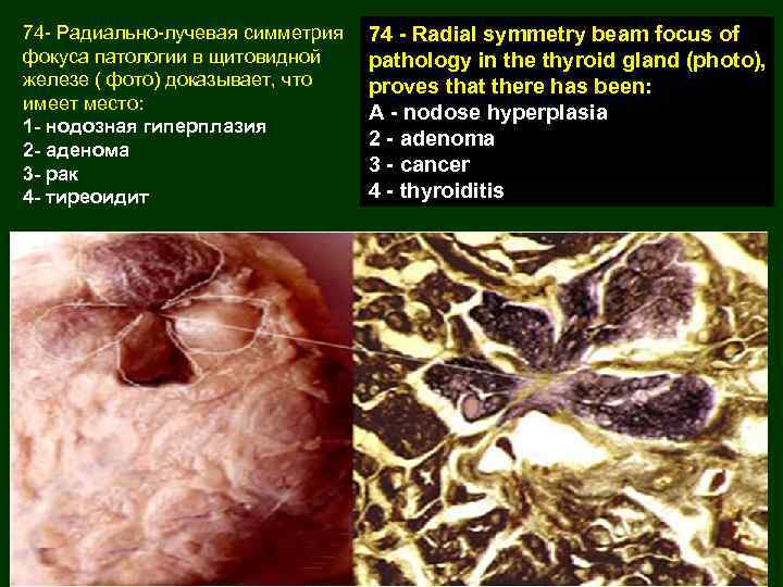74 - Радиально-лучевая симметрия фокуса патологии в щитовидной железе ( фото) доказывает, что имеет
