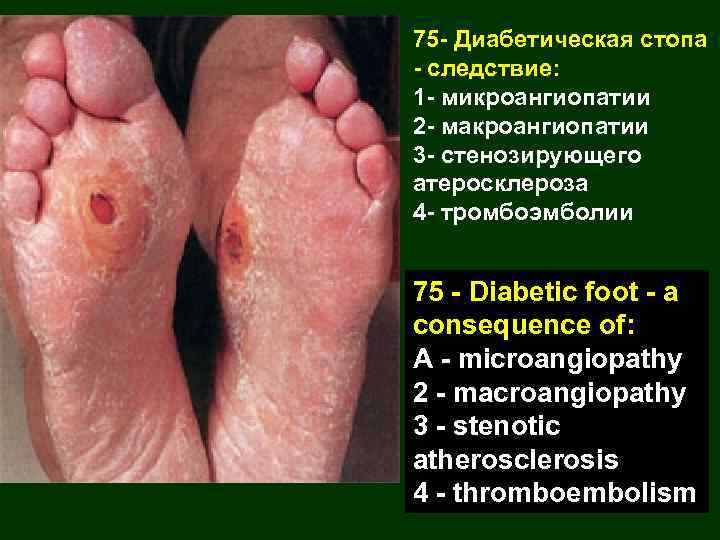 75 - Диабетическая стопа - следствие: 1 - микроангиопатии 2 - макроангиопатии 3 -