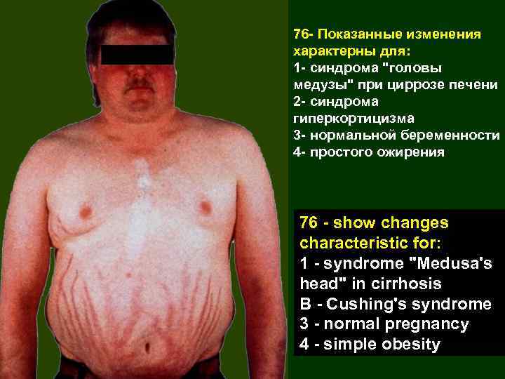 76 - Показанные изменения характерны для: 1 - синдрома "головы медузы" при циррозе печени