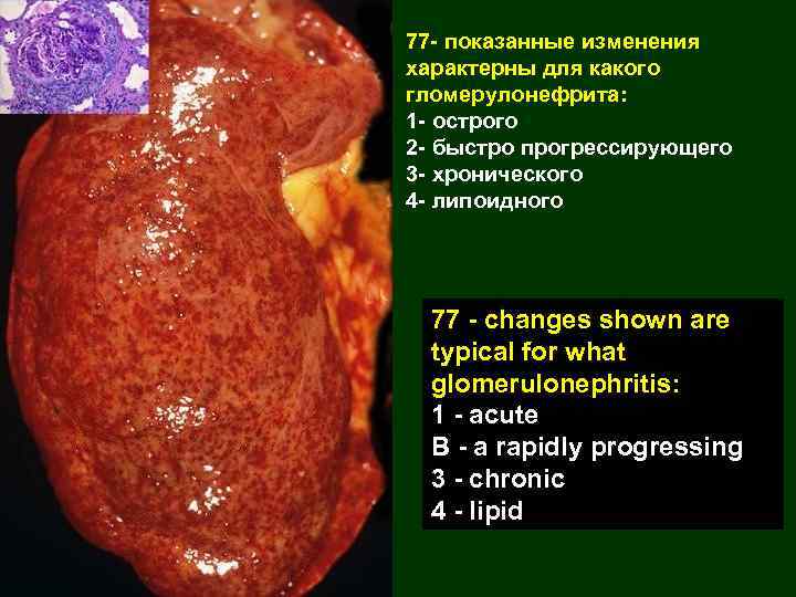 77 - показанные изменения характерны для какого гломерулонефрита: 1 - острого 2 - быстро
