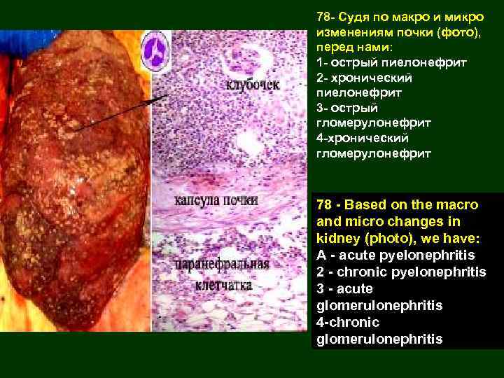78 - Судя по макро и микро изменениям почки (фото), перед нами: 1 -