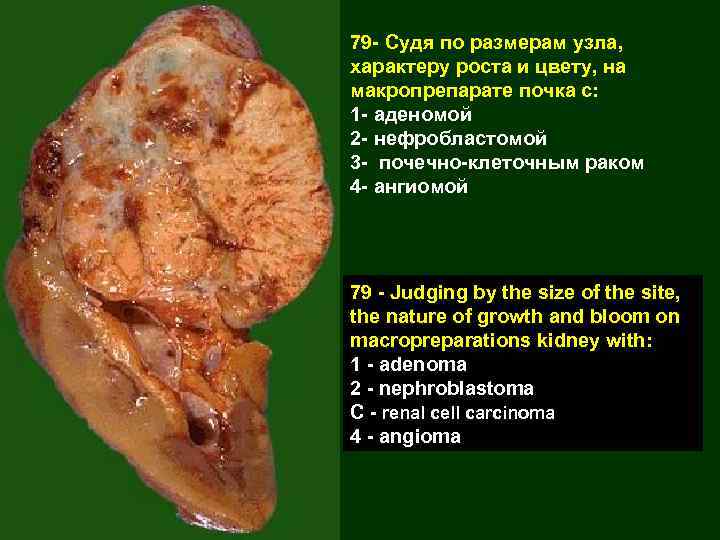 79 - Судя по размерам узла, характеру роста и цвету, на макропрепарате почка с: