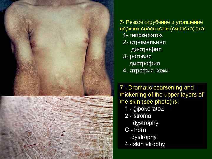 7 - Резкое огрубение и утолщение верхних слоев кожи (см. фото) это: 1 -