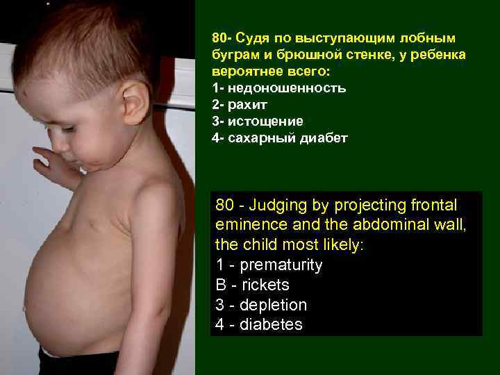 80 - Судя по выступающим лобным буграм и брюшной стенке, у ребенка вероятнее всего: