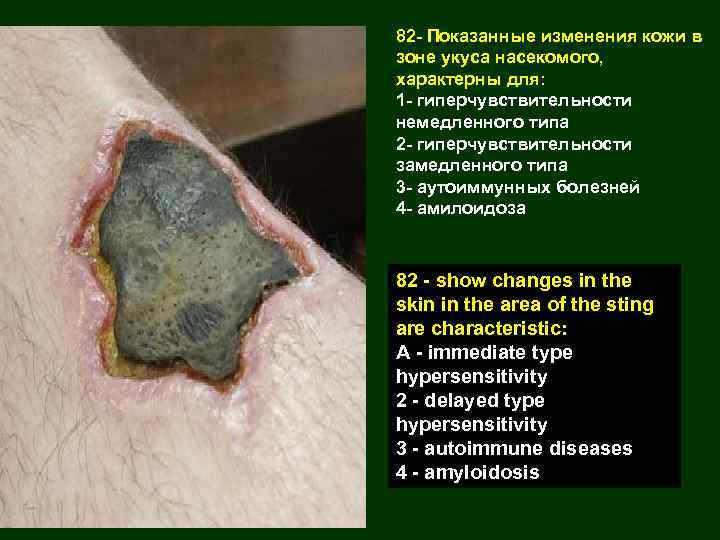 82 - Показанные изменения кожи в зоне укуса насекомого, характерны для: 1 - гиперчувствительности