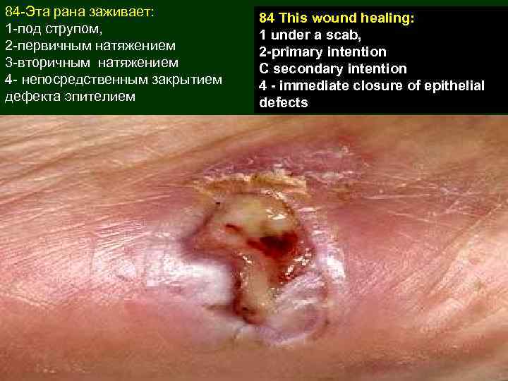 84 -Эта рана заживает: 1 -под струпом, 2 -первичным натяжением 3 -вторичным натяжением 4
