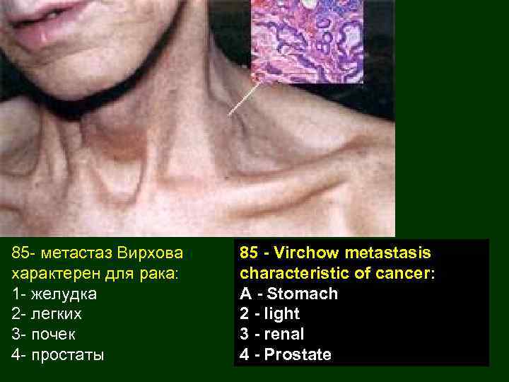 85 - метастаз Вирхова характерен для рака: 1 - желудка 2 - легких 3