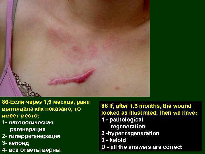 86 -Если через 1, 5 месяца, рана выглядела как показано, то имеет место: 1