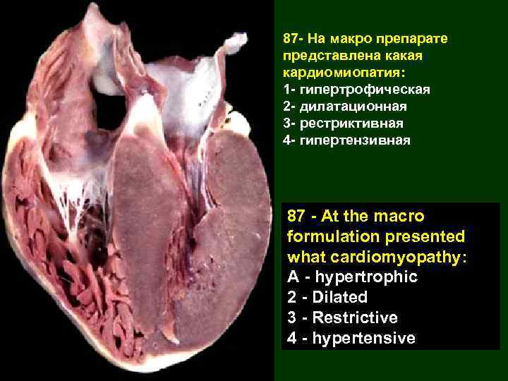 87 - На макро препарате представлена какая кардиомиопатия: 1 - гипертрофическая 2 - дилатационная