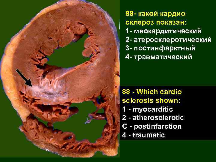 88 - какой кардио склероз показан: 1 - миокардитический 2 - атеросклеротический 3 -