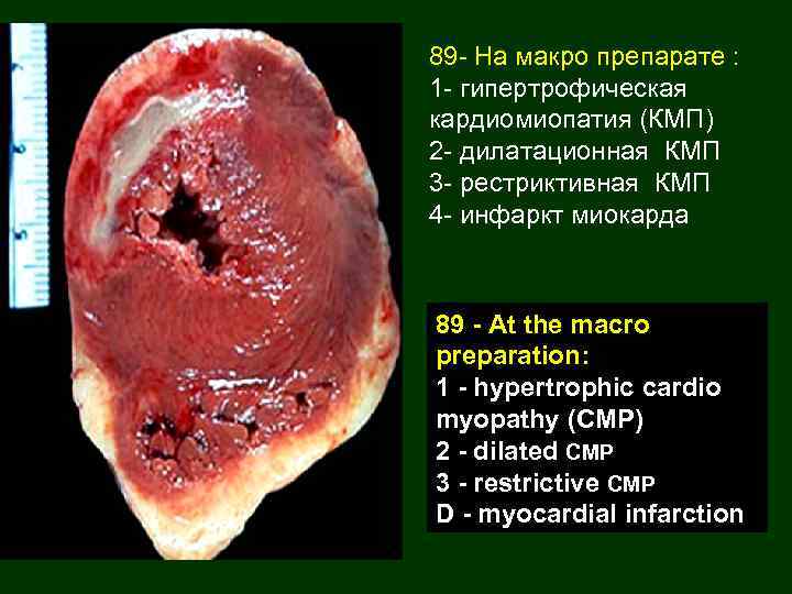 89 - На макро препарате : 1 - гипертрофическая кардиомиопатия (КМП) 2 - дилатационная