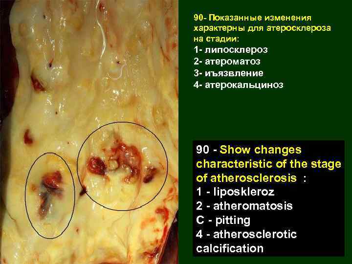 90 - Показанные изменения характерны для атеросклероза на стадии: 1 - липосклероз 2 -