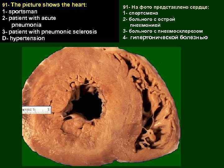 91 - The picture shows the heart: 1 - sportsman 2 - patient with