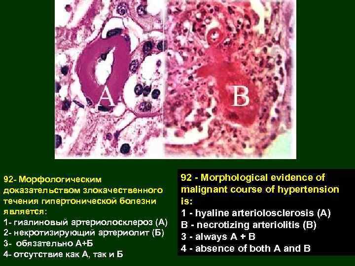 92 - Морфологическим доказательством злокачественного течения гипертонической болезни является: 1 - гиалиновый артериолосклероз (А)