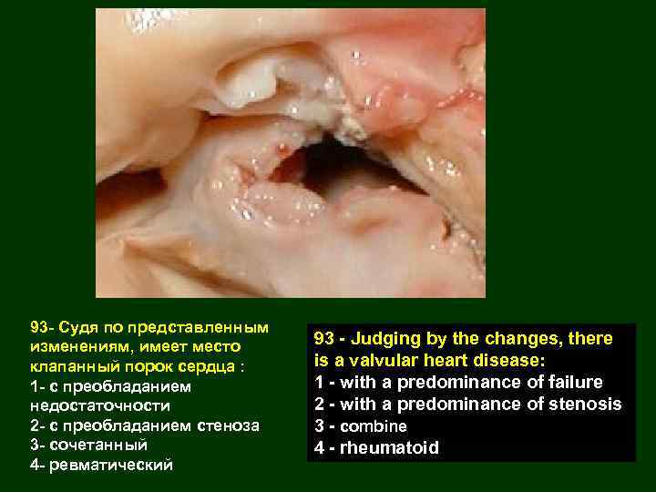 93 - Судя по представленным изменениям, имеет место клапанный порок сердца : 1 -