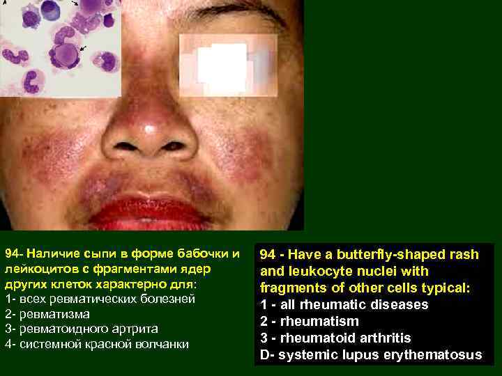 94 - Наличие сыпи в форме бабочки и лейкоцитов с фрагментами ядер других клеток
