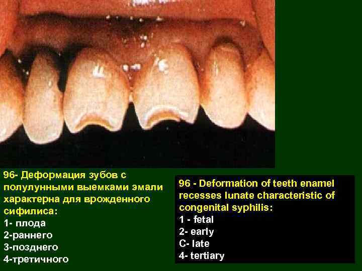 96 - Деформация зубов с полулунными выемками эмали характерна для врожденного сифилиса: 1 -