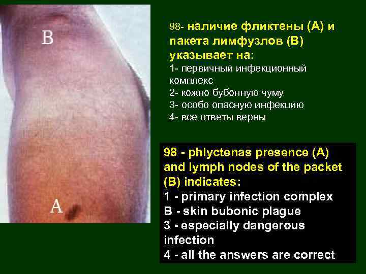 98 - наличие фликтены (А) и пакета лимфузлов (В) указывает на: 1 - первичный