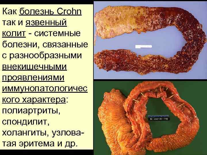 Как болезнь Crohn так и язвенный колит - системные болезни, связанные с разнообразными внекишечными