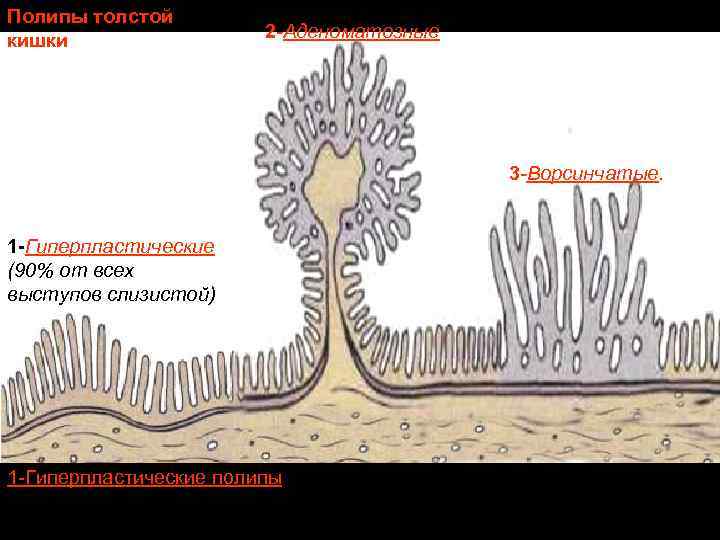 Полипы толстой кишки 2 -Аденоматозные 3 -Ворсинчатые. 1 -Гиперпластические (90% от всех выступов слизистой)