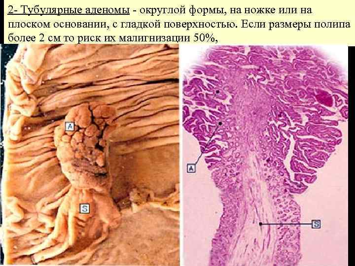 2 - Тубулярные аденомы - округлой формы, на ножке или на плоском основании, с