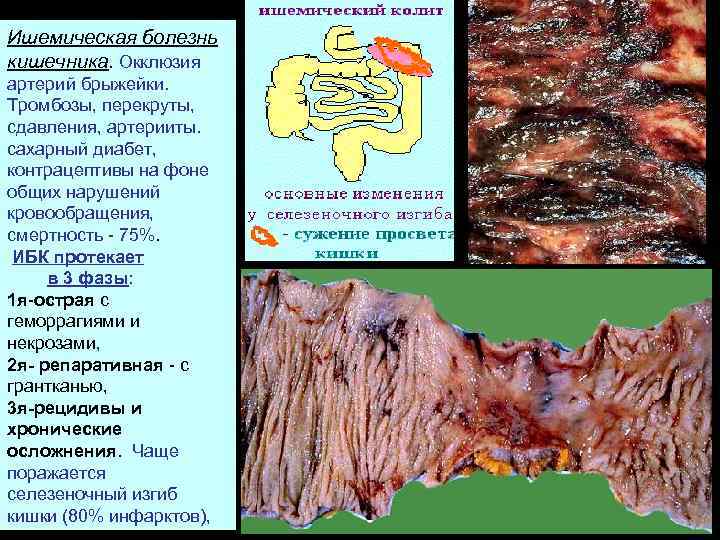 Ишемическая болезнь кишечника. Окклюзия артерий брыжейки. Тромбозы, перекруты, сдавления, артерииты. сахарный диабет, контрацептивы на