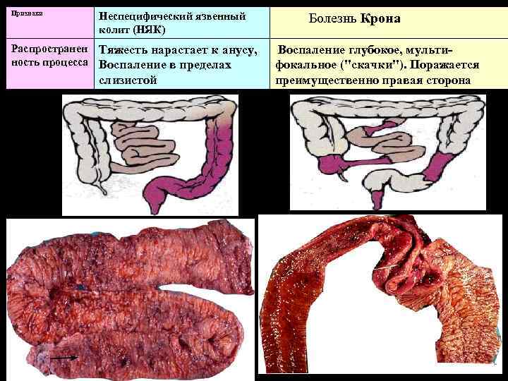 Признаки Неспецифический язвенный колит (НЯК) Распространен Тяжесть нарастает к анусу, ность процесса Воспаление в