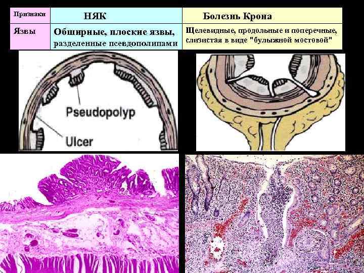 Признаки Язвы НЯК Обширные, плоские язвы, разделенные псевдополипами Болезнь Крона Щелевидные, продольные и поперечные,